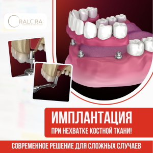 Рекламный баннер для OralOra — имплантация при нехватке костной ткани